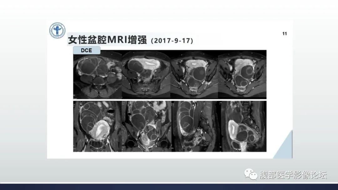 影像PPT - 【病例】卵巢过度刺激综合征1例MR影像-10