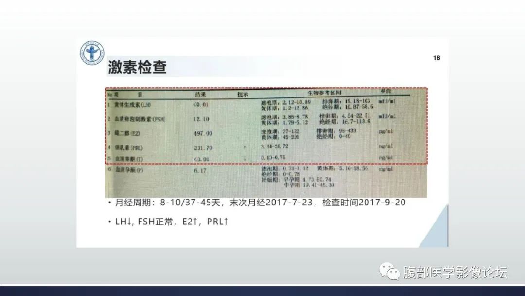 影像PPT - 【病例】卵巢过度刺激综合征1例MR影像-17