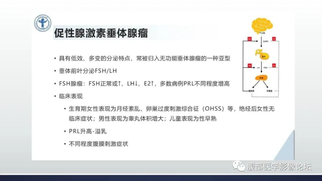 影像PPT - 【病例】卵巢过度刺激综合征1例MR影像-22