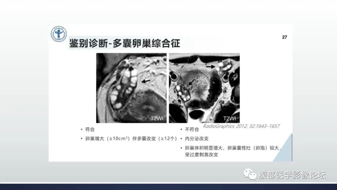 影像PPT - 【病例】卵巢过度刺激综合征1例MR影像-26