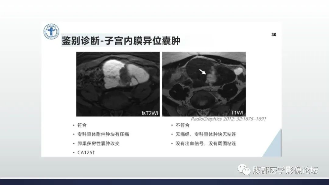 影像PPT - 【病例】卵巢过度刺激综合征1例MR影像-29