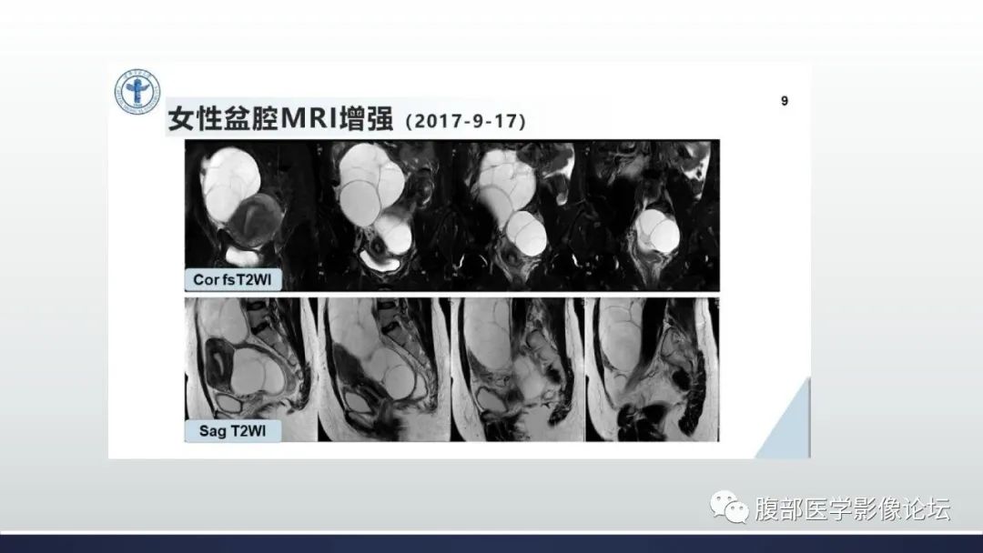 影像PPT - 【病例】卵巢过度刺激综合征1例MR影像-8