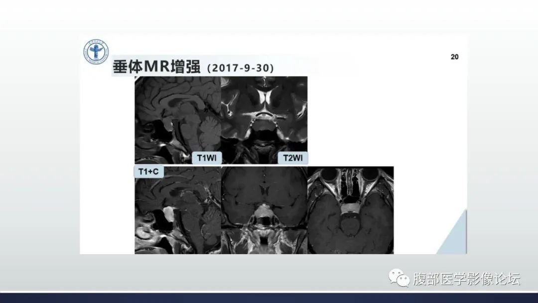 影像PPT - 【病例】卵巢过度刺激综合征1例MR影像-19