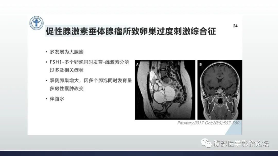 影像PPT - 【病例】卵巢过度刺激综合征1例MR影像-23