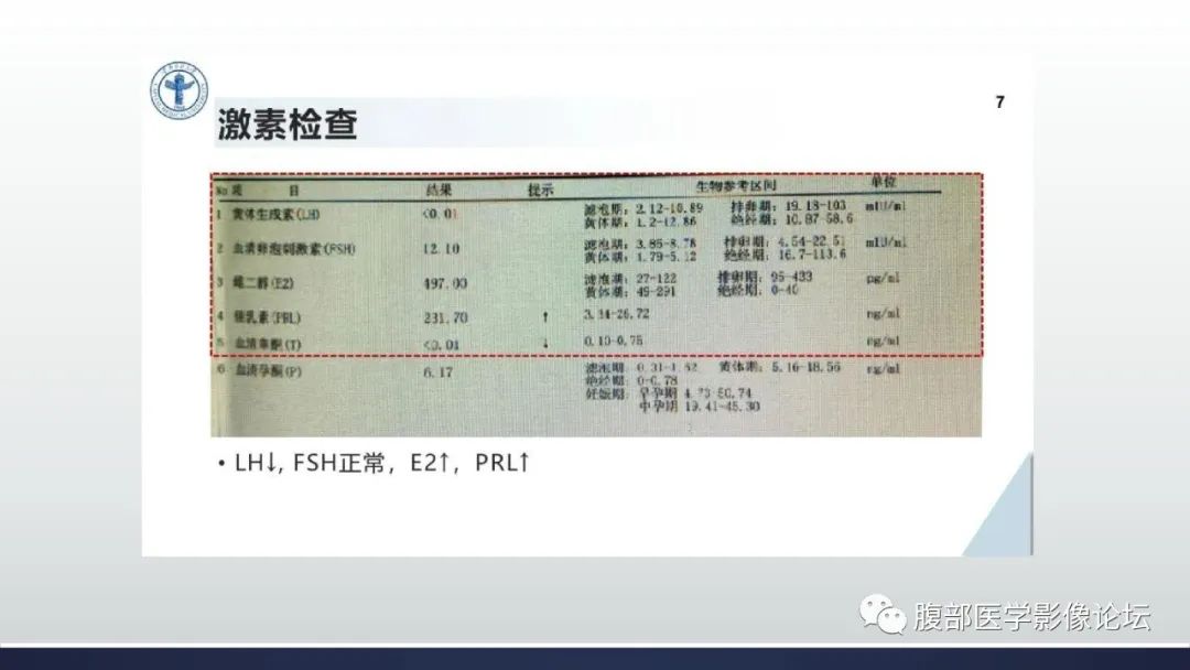 影像PPT - 【病例】卵巢过度刺激综合征1例MR影像-3