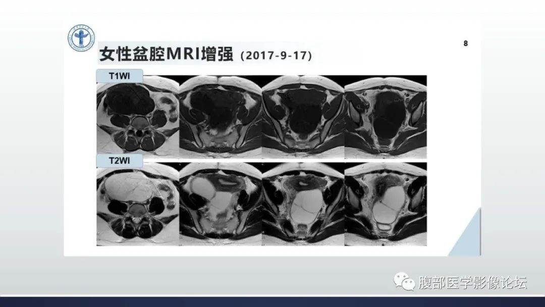 影像PPT - 【病例】卵巢过度刺激综合征1例MR影像-4