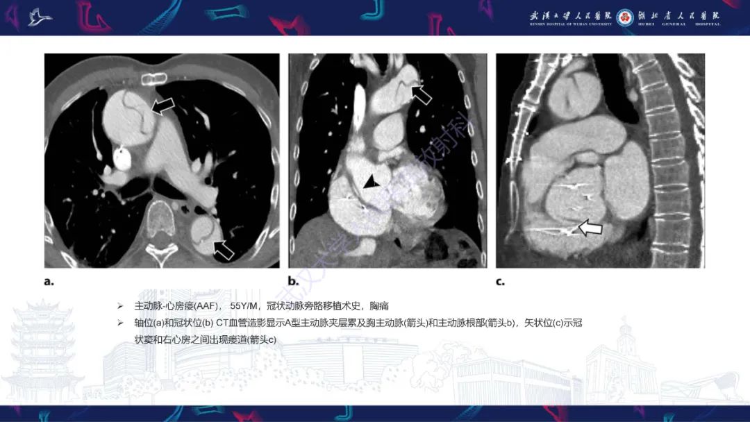 影像PPT - 【PPT】主动脉瘘影像诊断-13