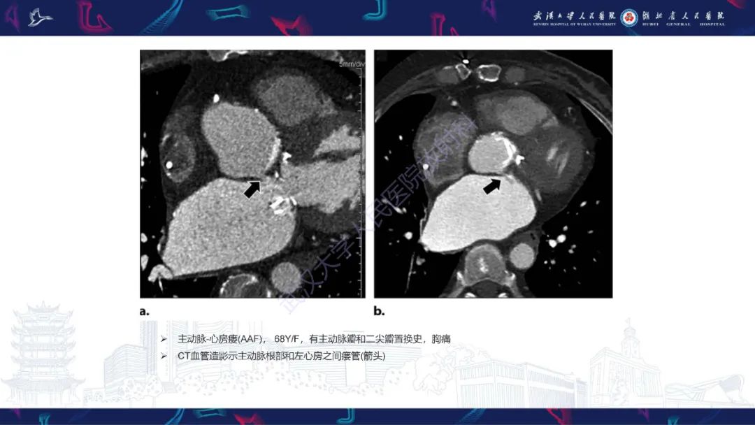 影像PPT - 【PPT】主动脉瘘影像诊断-14