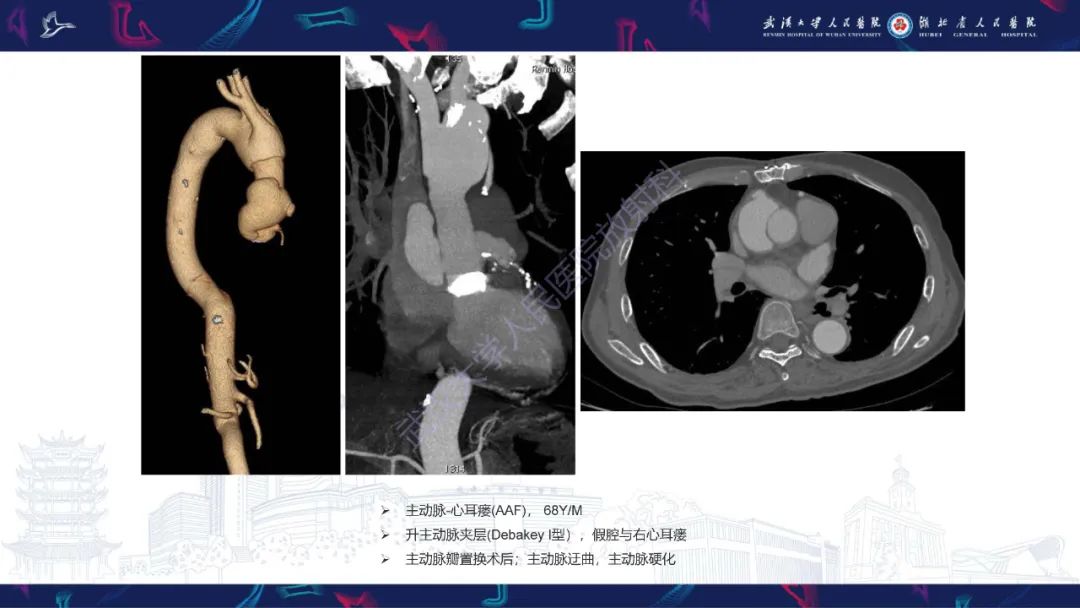 影像PPT - 【PPT】主动脉瘘影像诊断-15