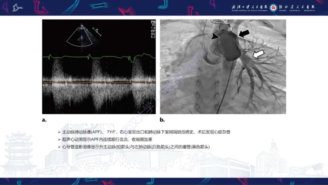 影像PPT - 【PPT】主动脉瘘影像诊断-17