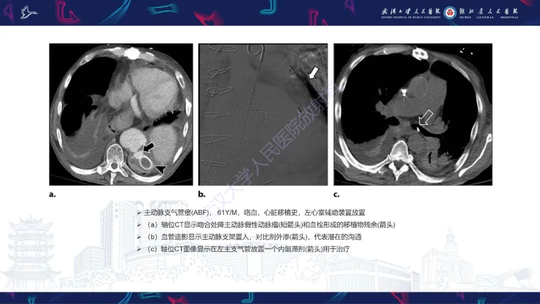影像PPT - 【PPT】主动脉瘘影像诊断-19
