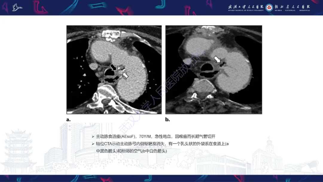影像PPT - 【PPT】主动脉瘘影像诊断-21
