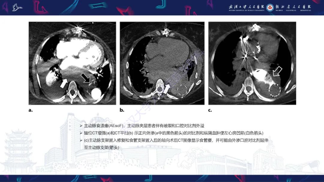 影像PPT - 【PPT】主动脉瘘影像诊断-22