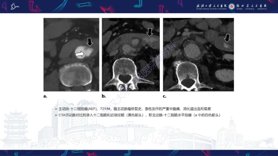 影像PPT - 【PPT】主动脉瘘影像诊断-26
