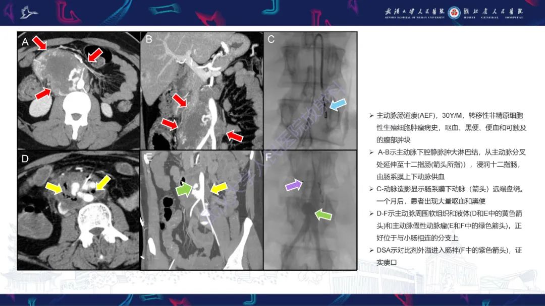 影像PPT - 【PPT】主动脉瘘影像诊断-27