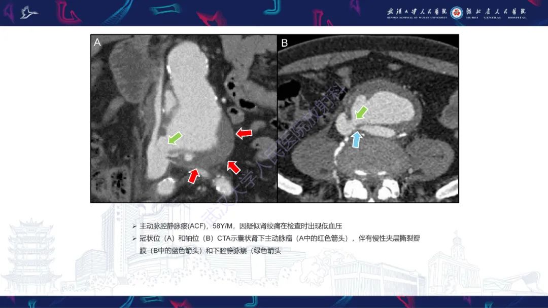 影像PPT - 【PPT】主动脉瘘影像诊断-30