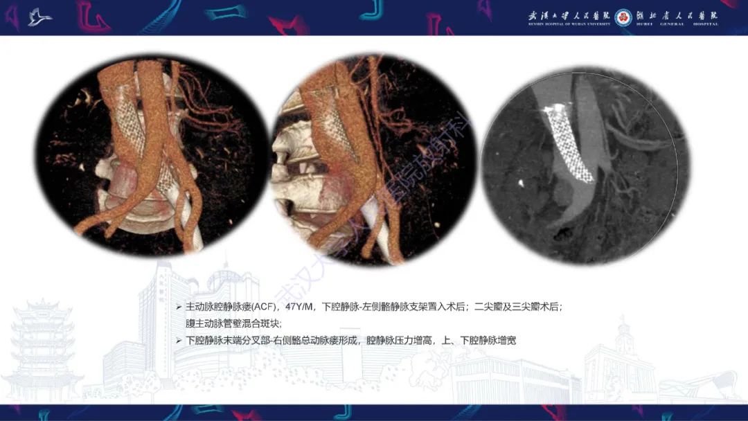 影像PPT - 【PPT】主动脉瘘影像诊断-31