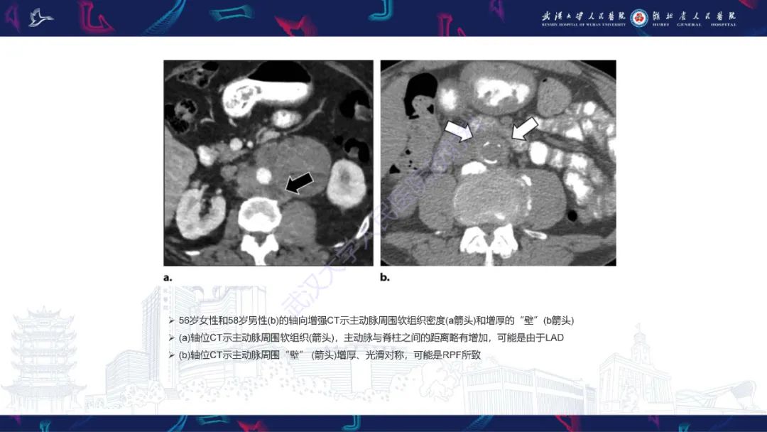影像PPT - 【PPT】主动脉瘘影像诊断-37