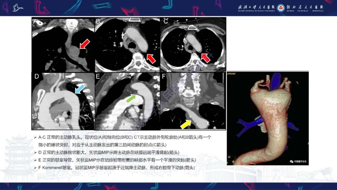 影像PPT - 【PPT】主动脉瘘影像诊断-33