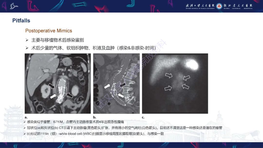 影像PPT - 【PPT】主动脉瘘影像诊断-34