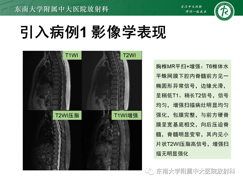 影像PPT - 【PPT】髓外硬膜下肿瘤-2