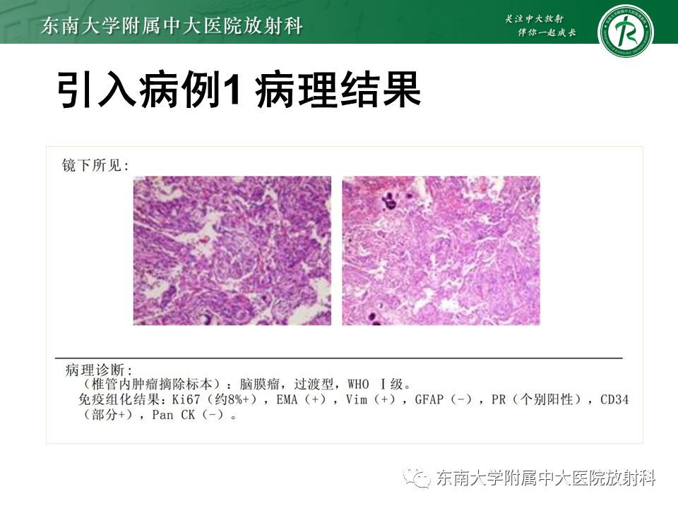 影像PPT - 【PPT】髓外硬膜下肿瘤-3