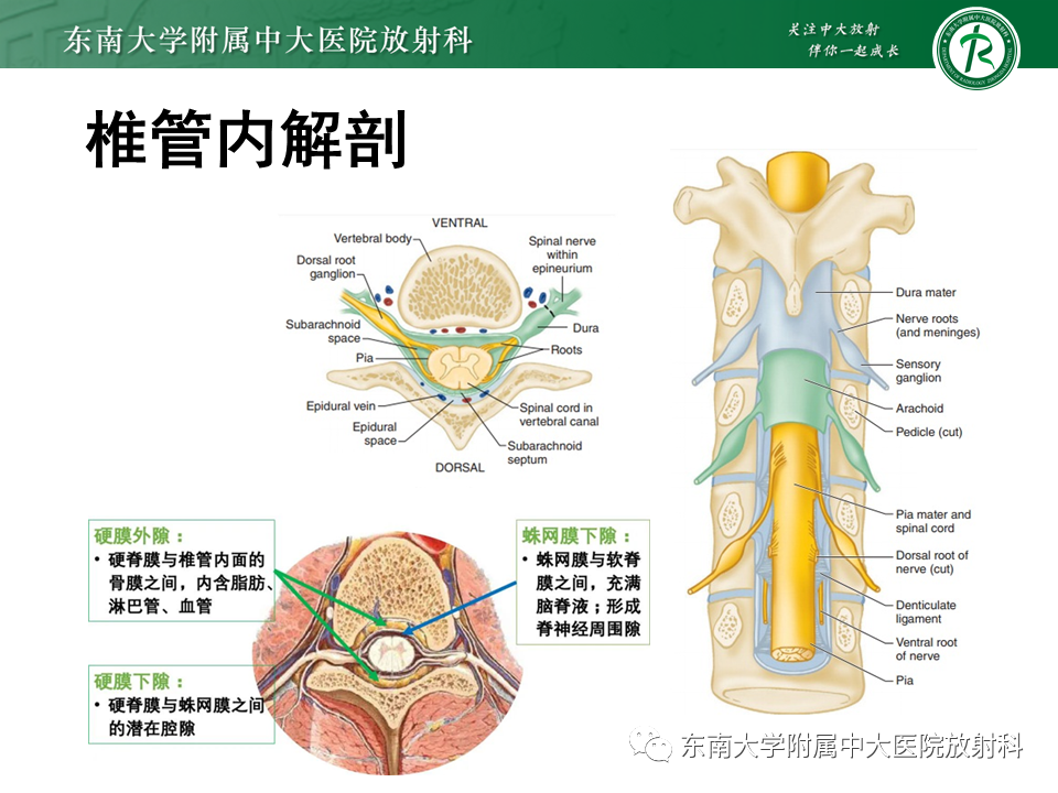 影像PPT - 【PPT】髓外硬膜下肿瘤-5
