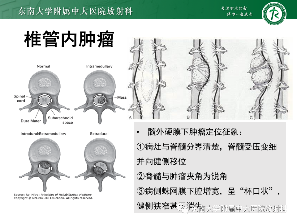 影像PPT - 【PPT】髓外硬膜下肿瘤-6