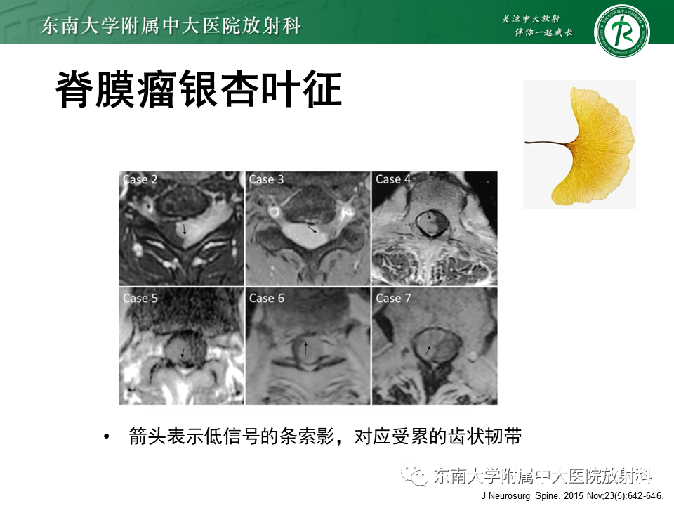 影像PPT - 【PPT】髓外硬膜下肿瘤-14