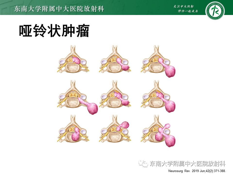 影像PPT - 【PPT】髓外硬膜下肿瘤-22