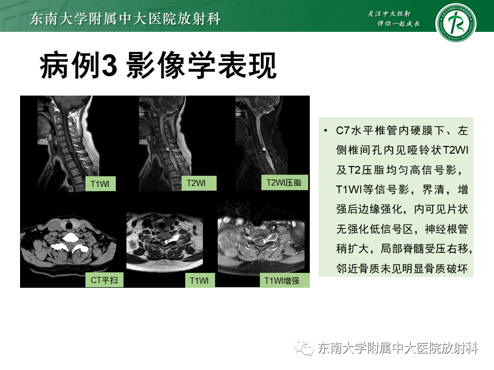 影像PPT - 【PPT】髓外硬膜下肿瘤-24