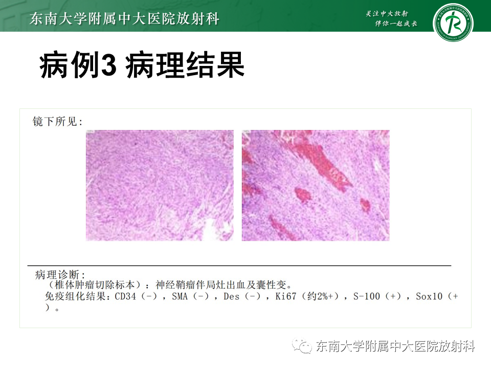 影像PPT - 【PPT】髓外硬膜下肿瘤-25