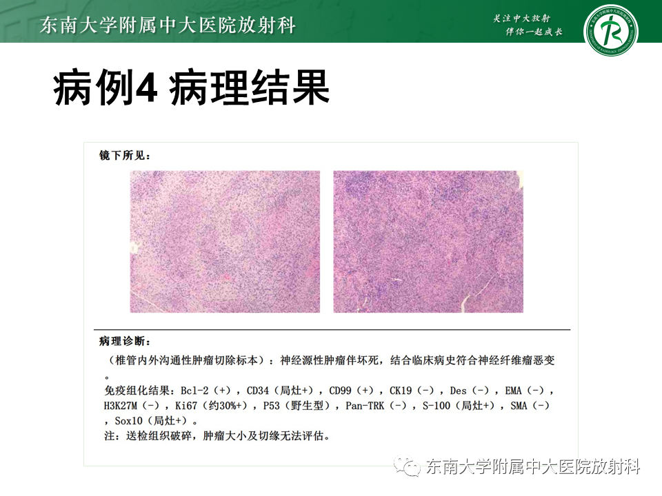 影像PPT - 【PPT】髓外硬膜下肿瘤-35