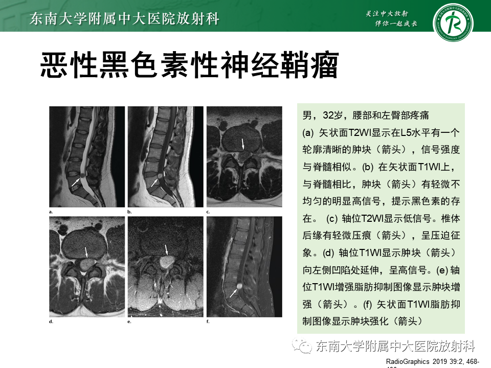 影像PPT - 【PPT】髓外硬膜下肿瘤-39