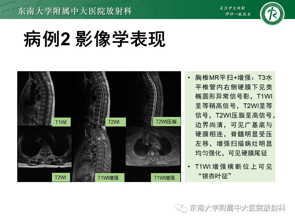 影像PPT - 【PPT】髓外硬膜下肿瘤-16