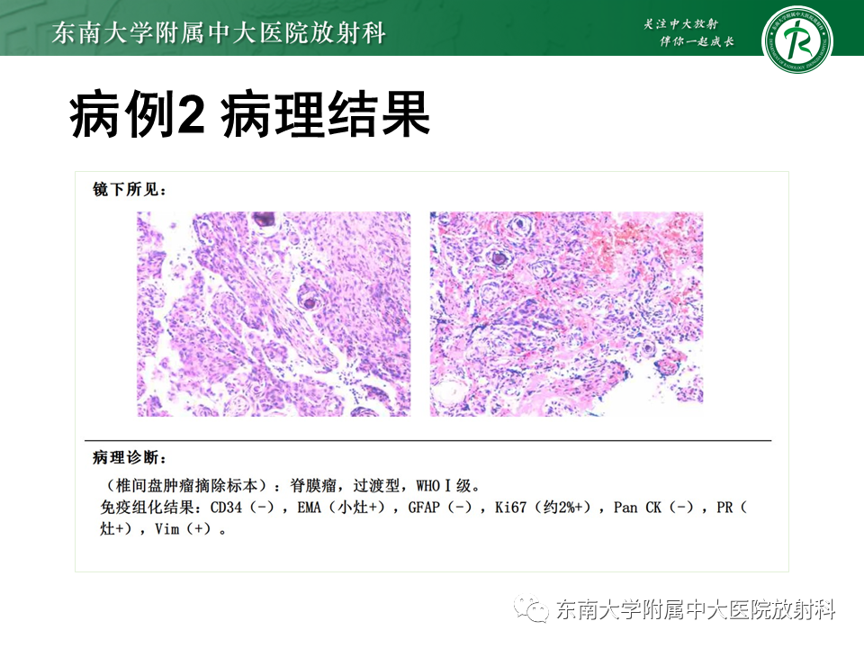 影像PPT - 【PPT】髓外硬膜下肿瘤-17