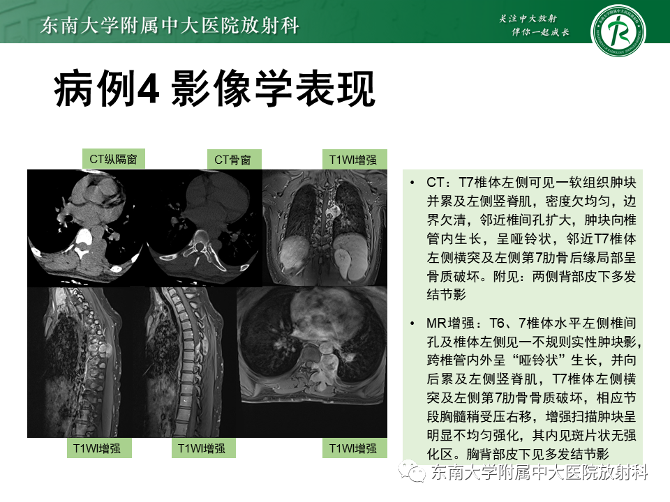 影像PPT - 【PPT】髓外硬膜下肿瘤-34