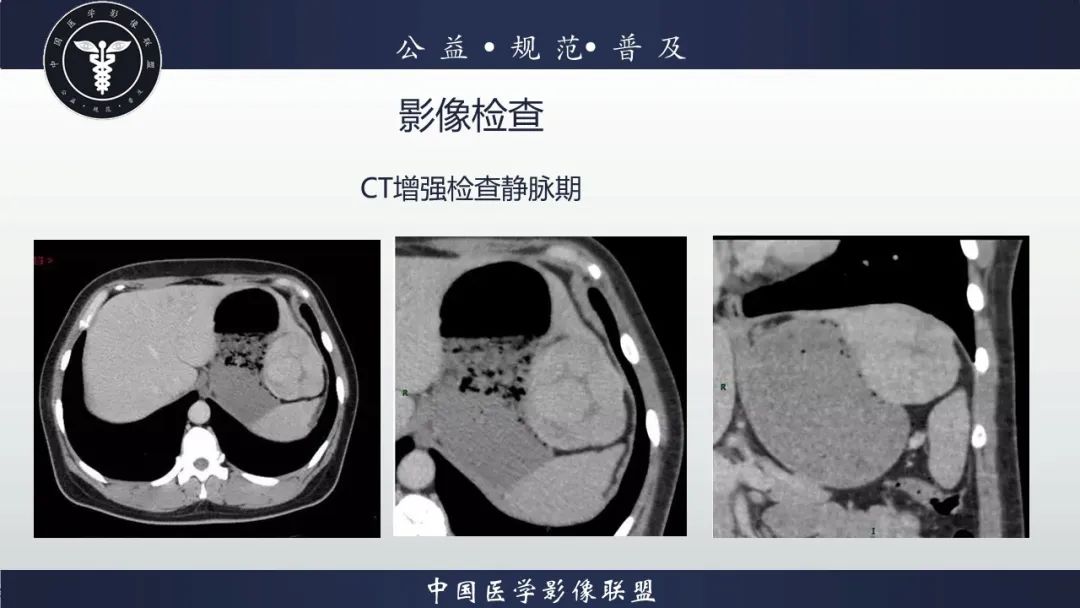 影像PPT - 【病例】肝脏局灶性结节增生1例CT及MR影像-3