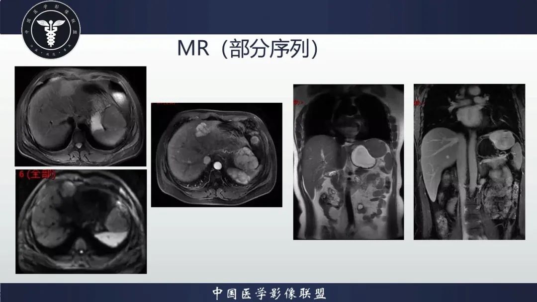影像PPT - 【病例】肝脏局灶性结节增生1例CT及MR影像-4