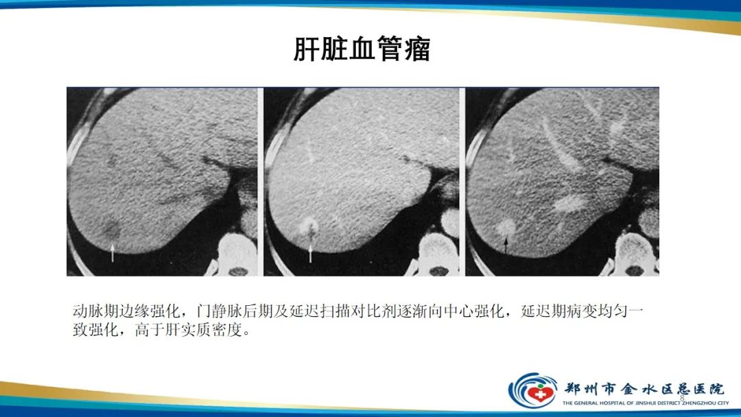 影像PPT - 【PPT】肝血管瘤影像学表现-8