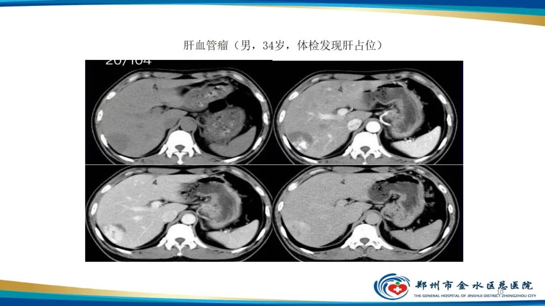 影像PPT - 【PPT】肝血管瘤影像学表现-10