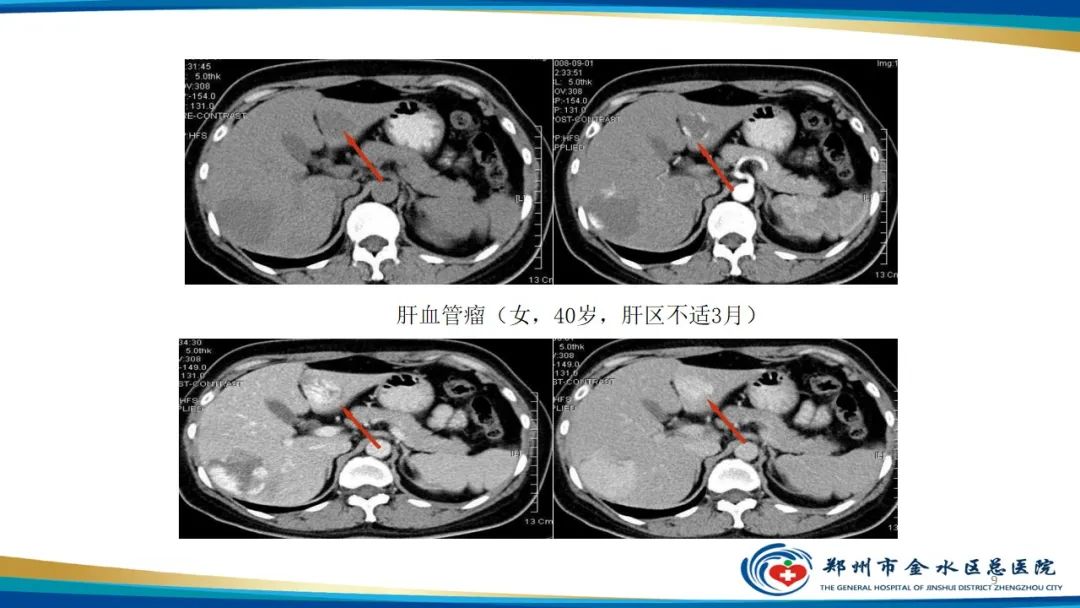 影像PPT - 【PPT】肝血管瘤影像学表现-9