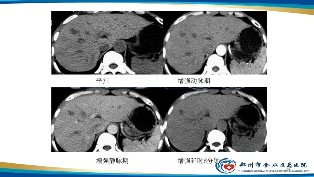 影像PPT - 【PPT】肝血管瘤影像学表现-24