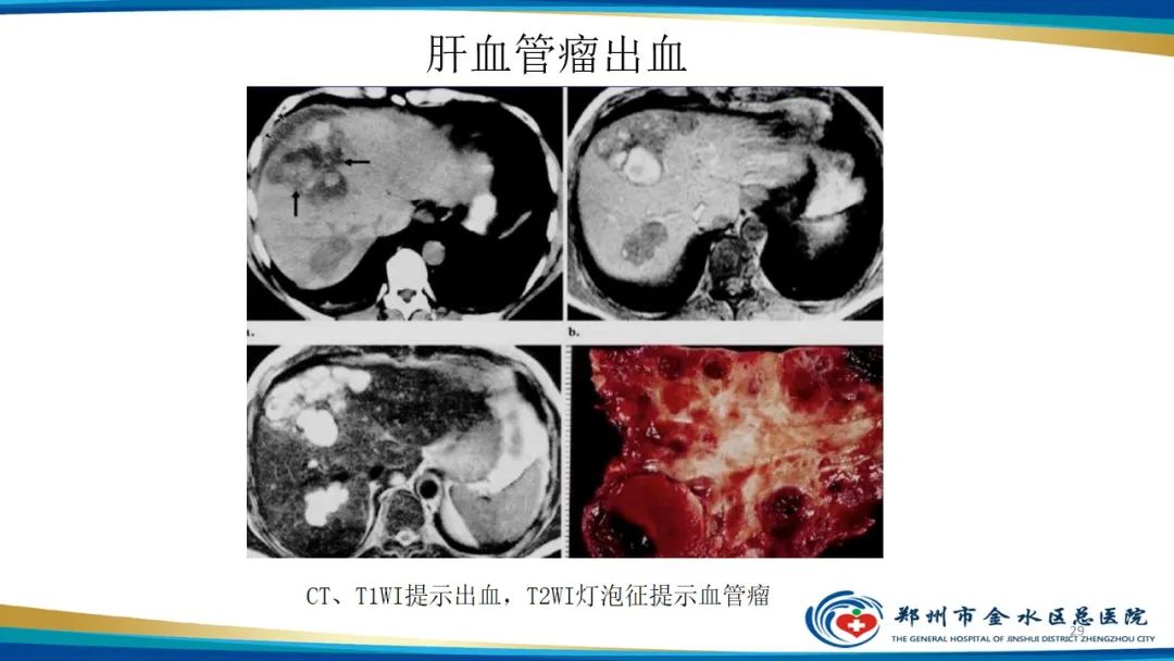 影像PPT - 【PPT】肝血管瘤影像学表现-29
