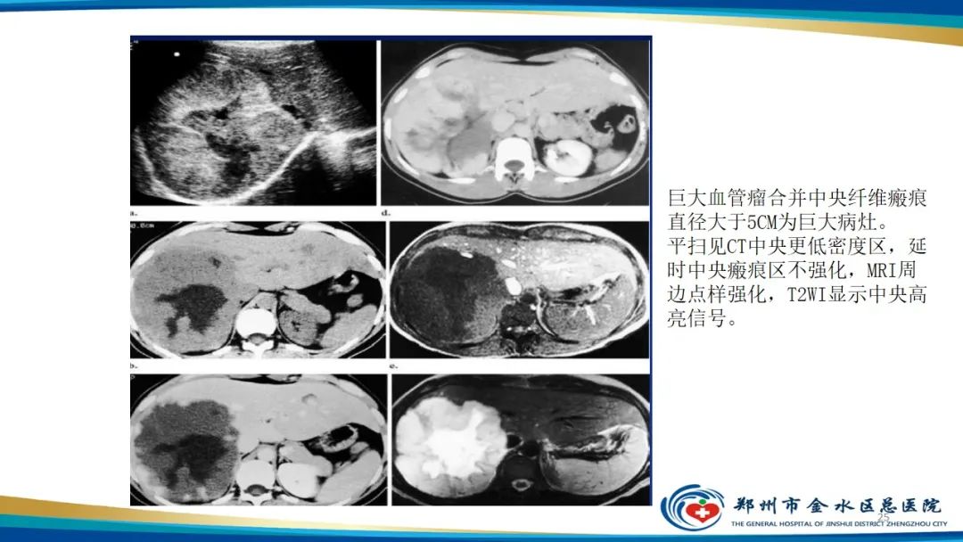影像PPT - 【PPT】肝血管瘤影像学表现-25