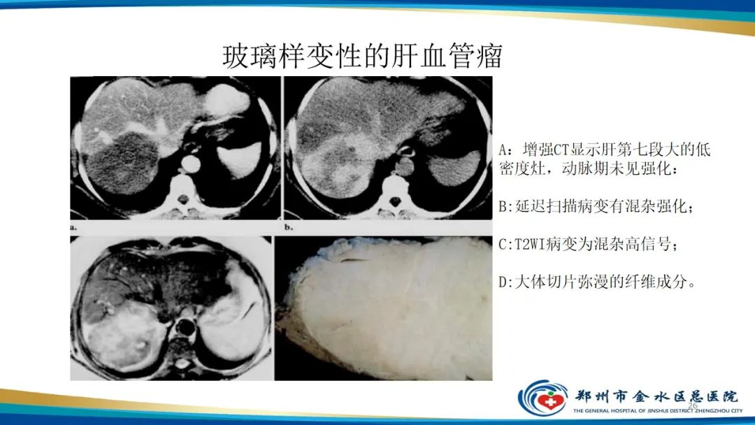 影像PPT - 【PPT】肝血管瘤影像学表现-26