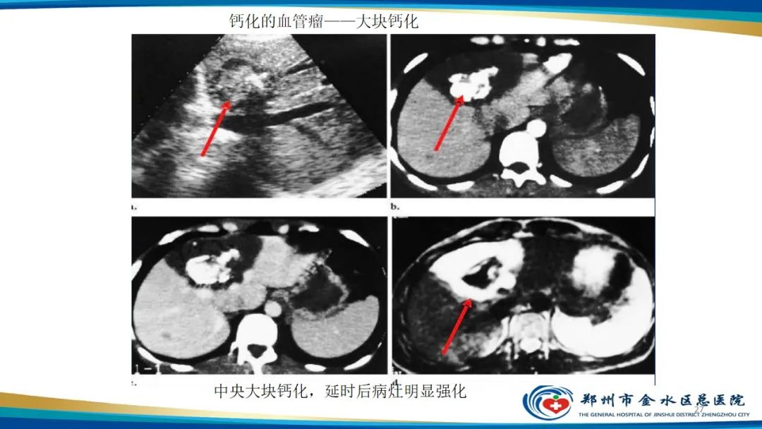 影像PPT - 【PPT】肝血管瘤影像学表现-27