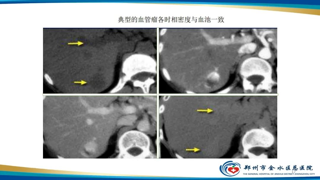 影像PPT - 【PPT】肝血管瘤影像学表现-17