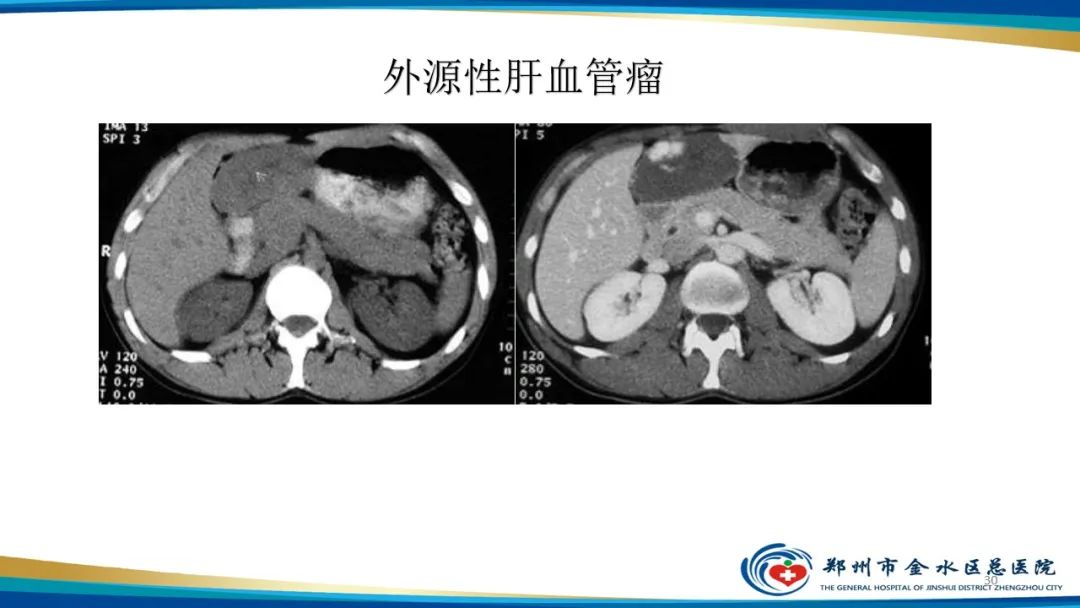 影像PPT - 【PPT】肝血管瘤影像学表现-30