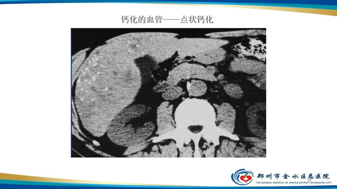 影像PPT - 【PPT】肝血管瘤影像学表现-28